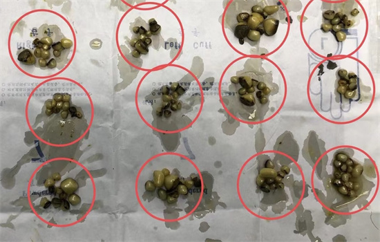 【湖北日報(bào)】女子膽囊長“沙包”內(nèi)藏千粒結(jié)石 預(yù)防勝于治療：日常做到管住嘴邁開腿