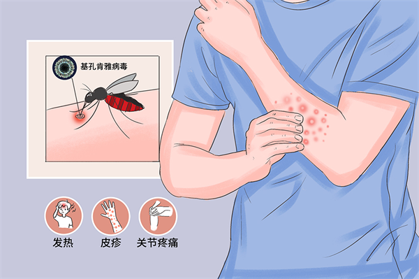 蚊子傳播的基孔肯雅熱，防護(hù)要點(diǎn)看這里