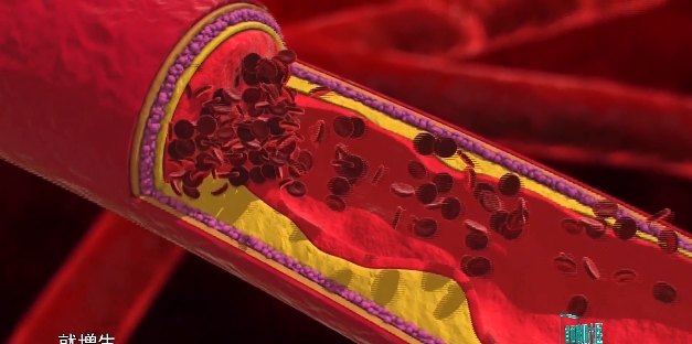 【直通襄陽(yáng)六醫(yī)】人工血管內(nèi)置支架，打通血透患者“生命線”