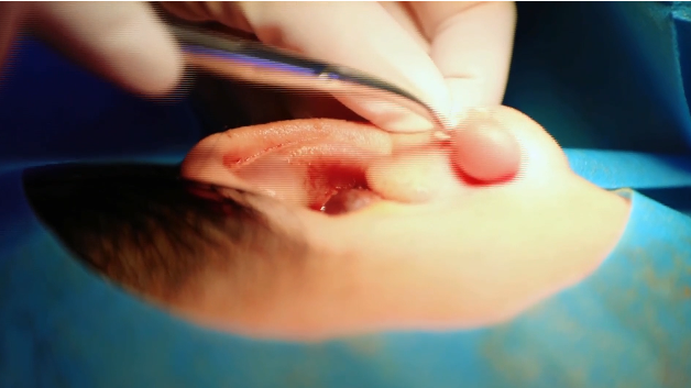 【直通襄陽(yáng)六醫(yī)】耳洞感染長(zhǎng)肉球 手術(shù)放療雙管齊下